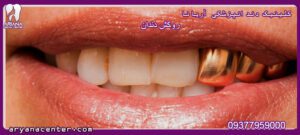 قیمت روکش دندان کلینیک دندانپزشکی آریانا