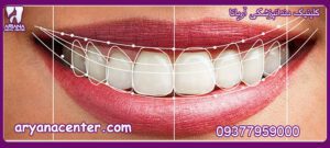 اصلاح طراحی لبخند کلینیک دندانپزشکی آریانا
