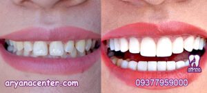 کامپوزیت دندان برای چه سنی مناسب است؟