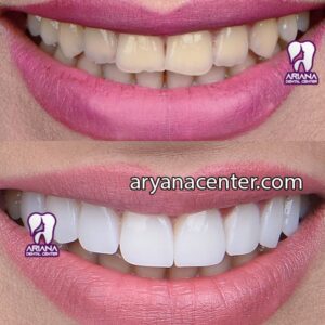 قبل و بعد بلیچینگ دندان
