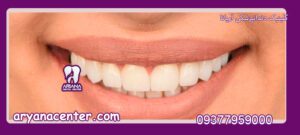 قیمت کامپوزیت دندان 1401