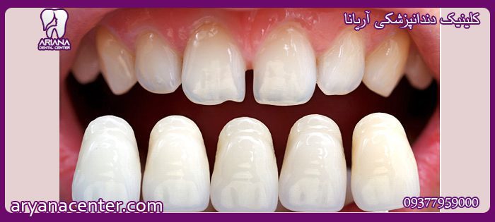 لمینت دندان کلینیک دندانپزشکی اریانا 
