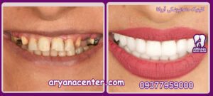 عکس قبل و بعد کامپوزیت دندان