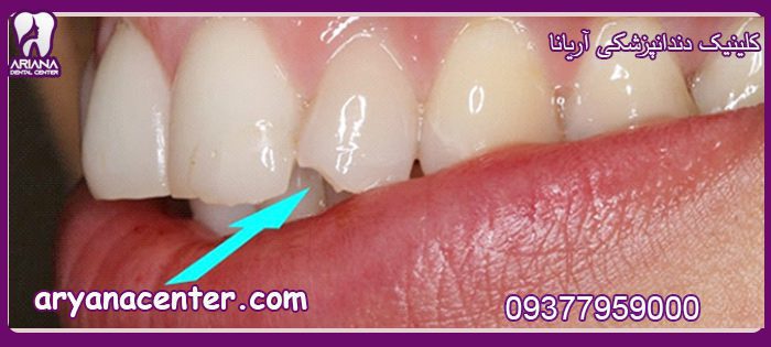 عوارض کامپوزیت دندان چیست 