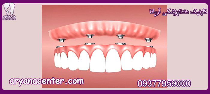 تفاوت پروتز دندان و ایمپلنت دندان