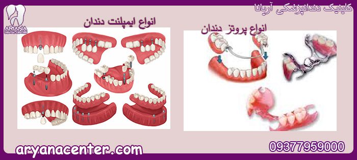 تفاوت پروتز دندان و ایمپلنت دندان
