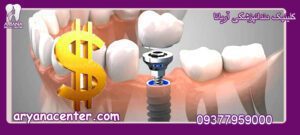 قیمت ایمپلنت دندان 1401