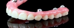 تفاوت پروتز دندان و ایمپلنت دندان چیست؟