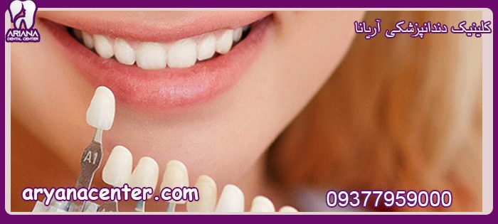 عوارض کامپوزیت دندان چیست ؟