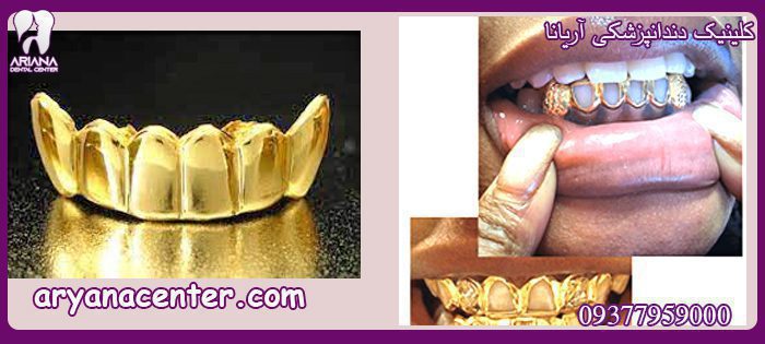 ایمپلنت دندان طلا کلینیک دندانپزشکی آریانا