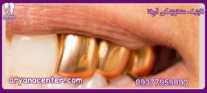 عکس لمینت دندان طلا